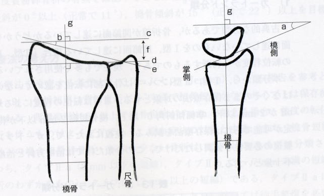 尺骨突き上げ症候群の見極め Kazuya整骨君のひとりごと